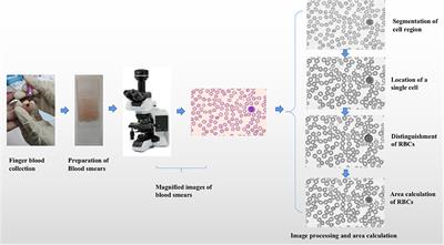 Measurement for the Area of Red Blood Cells From Microscopic Images Based on Image Processing Technology and Its Applications in Aplastic Anemia, Megaloblastic Anemia, and Myelodysplastic Syndrome